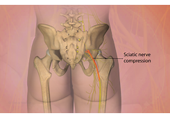  Sciatica Treatment